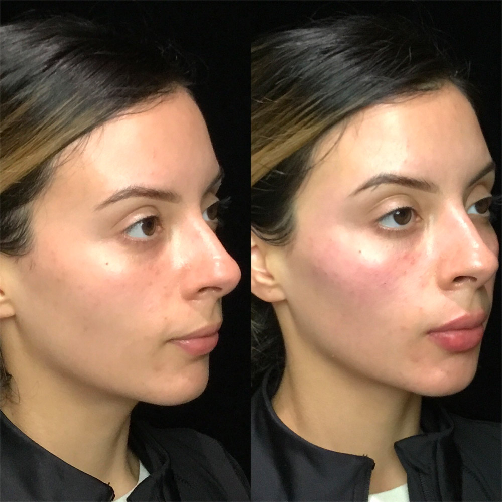Juvederm Before & After 1