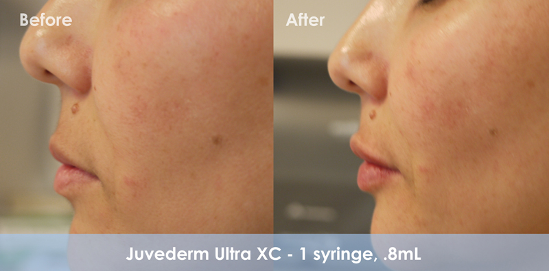 Juvederm Before & After 2
