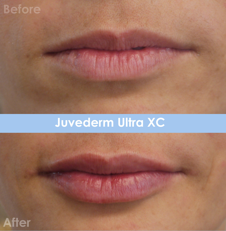Juvederm Before & After 5