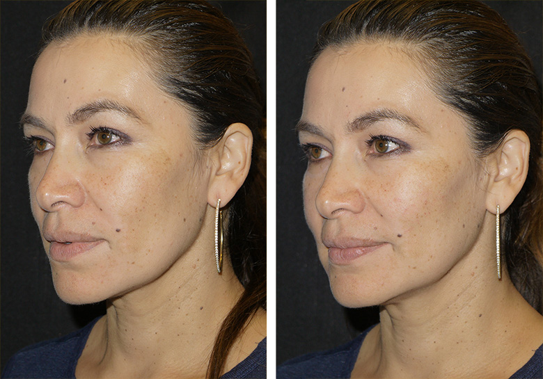 Juvederm Before & After 6