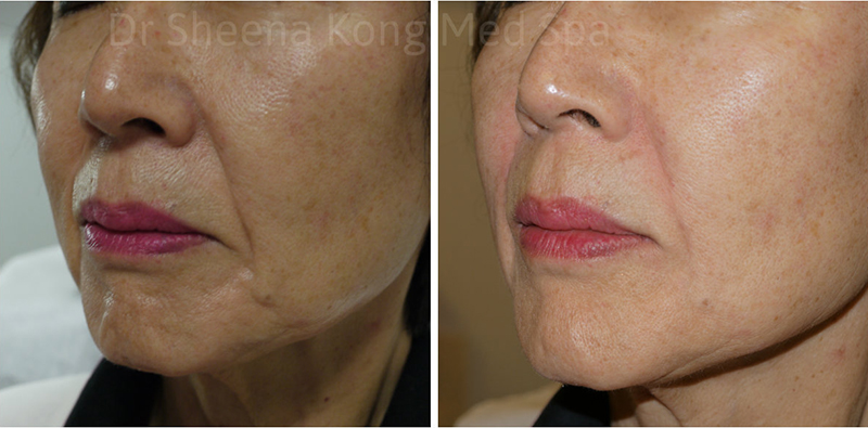Juvederm Before & After 7