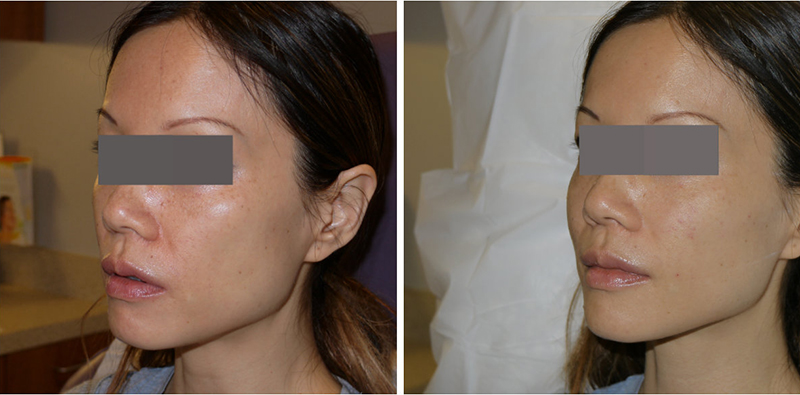 Juvederm Before & After 8