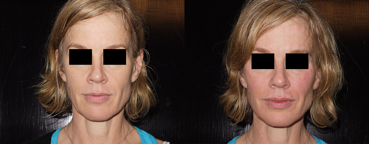 Juvederm Before & After 9
