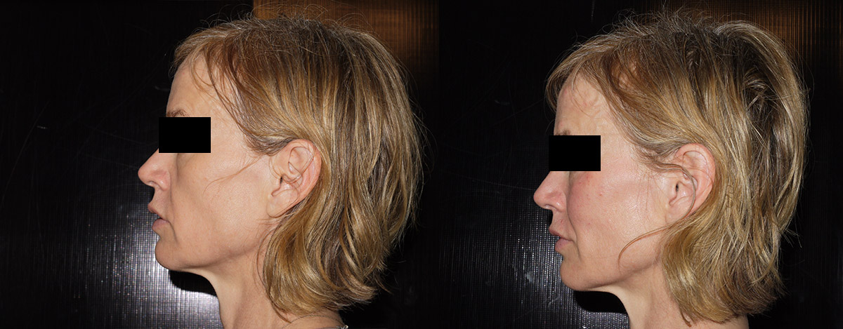 Juvederm Before & After 9