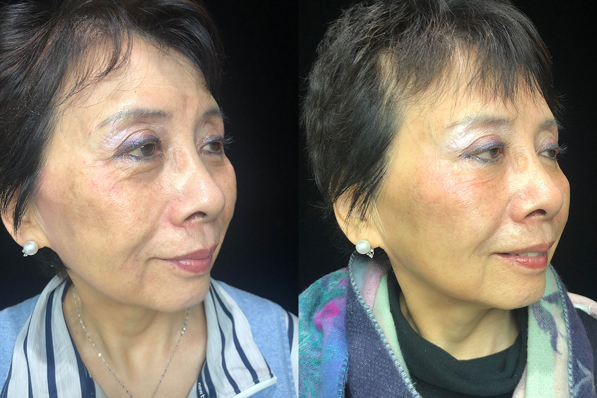 Juvederm Before & After 10