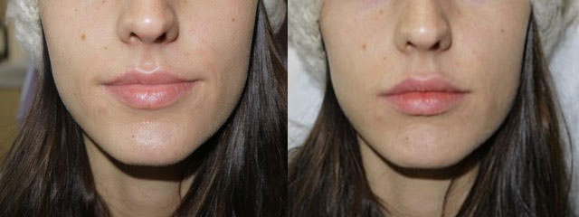 Juvederm Before & After 11