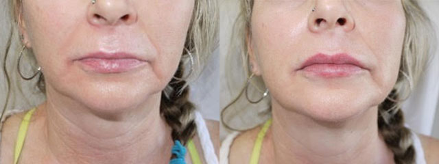 Juvederm Before & After 12