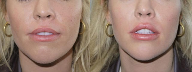 Juvederm Before & After 13