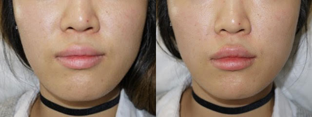 Juvederm Before & After 14