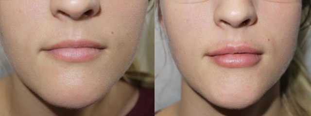 Juvederm Before & After 15