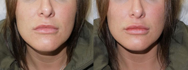 Juvederm Before & After 16