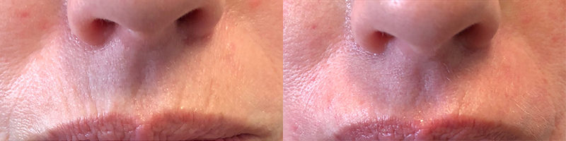 Juvederm Before & After 17
