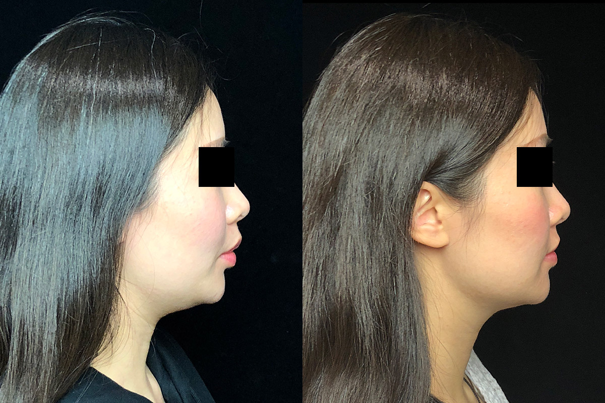 Kybella Before & After 1