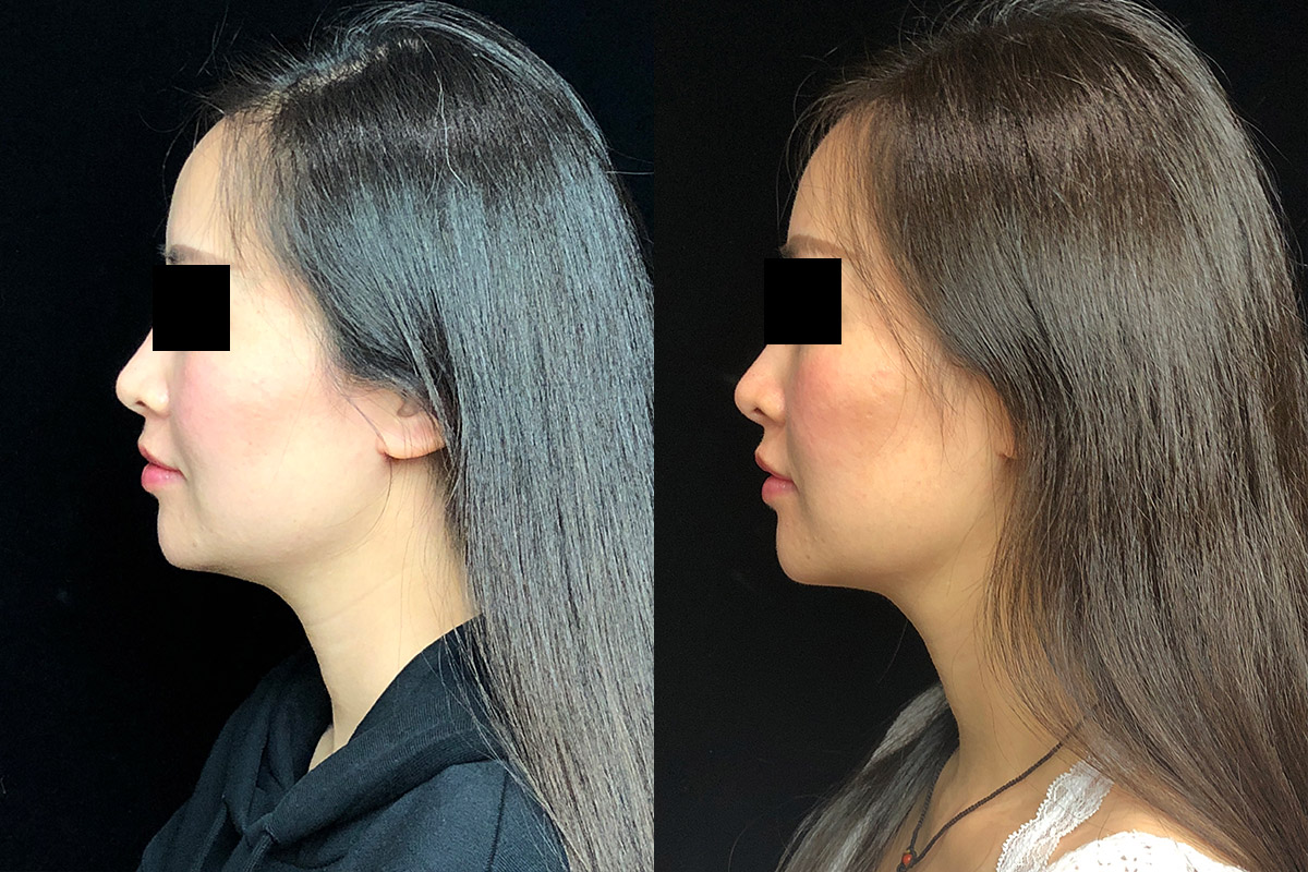 Kybella Before & After 1