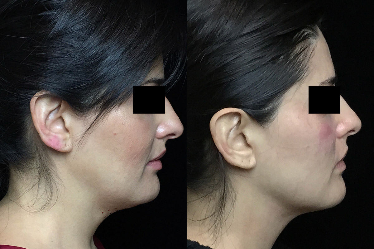 Kybella Before & After 2