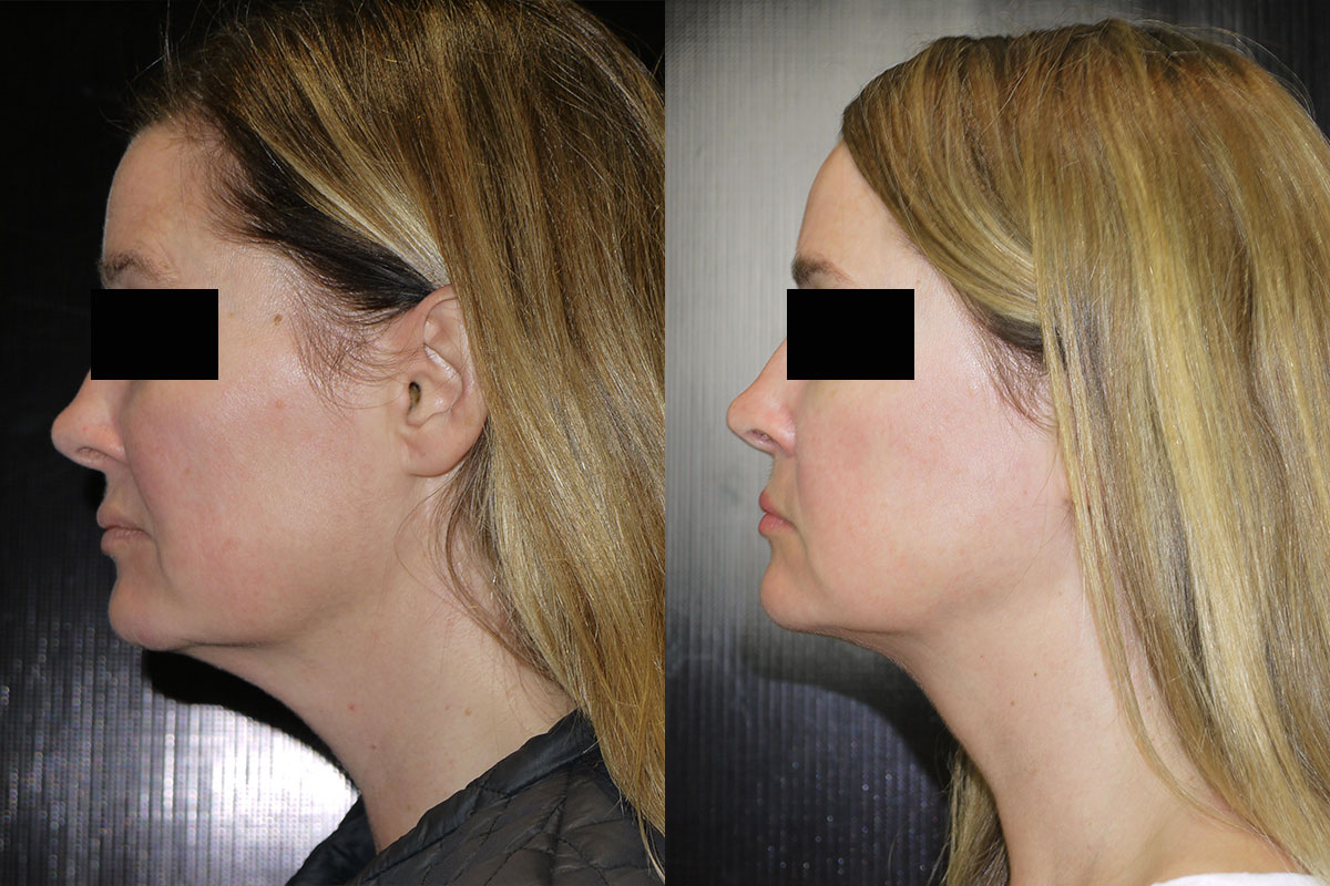 Kybella Before & After 3