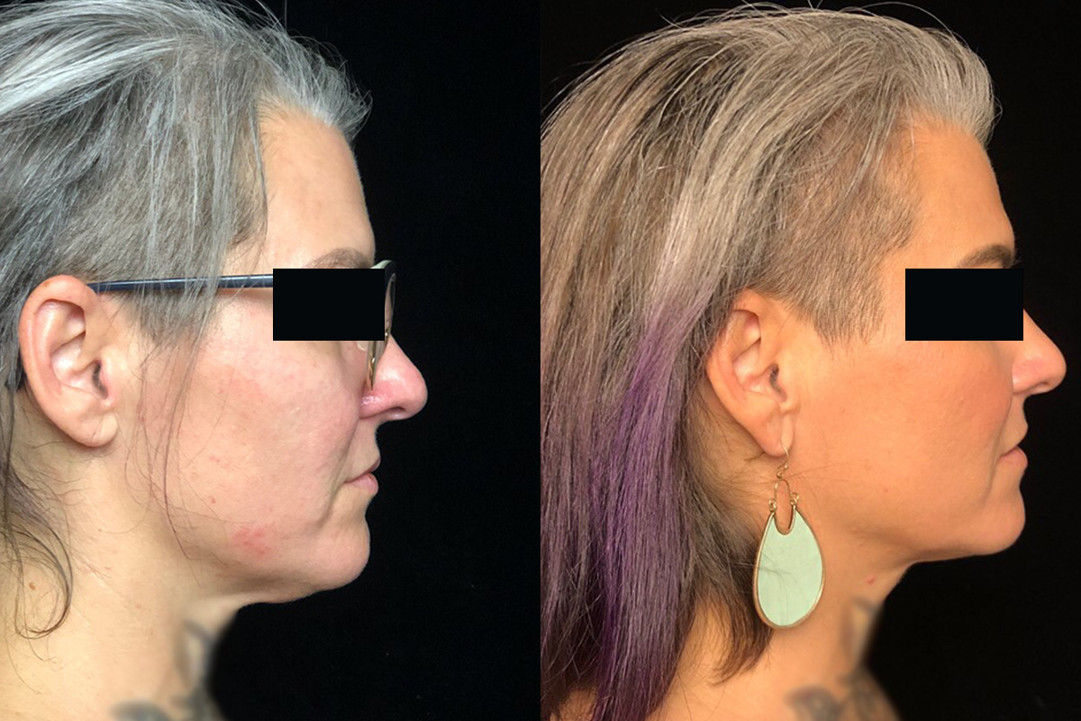 Kybella Before & After 4