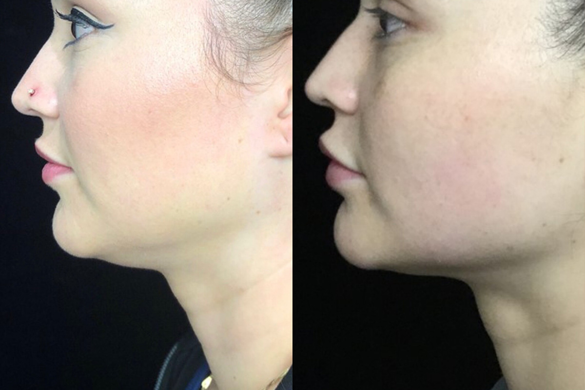 Kybella Before & After 6
