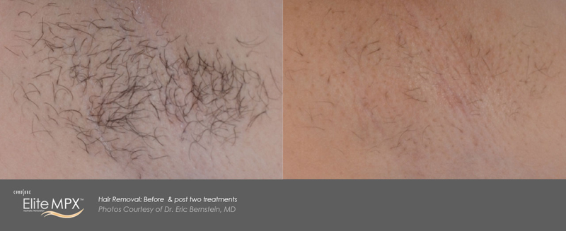 Laser Hair Removal Before & After 2