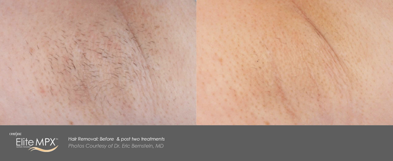Laser Hair Removal Before & After 3