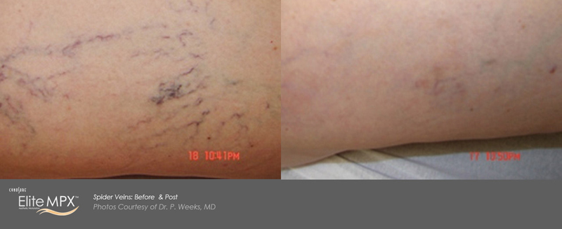 Laser Vein Removal Before & After 1