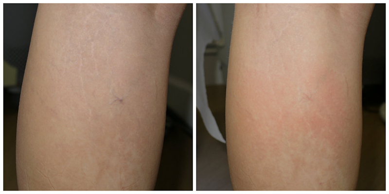 Laser Vein Removal Before & After 2