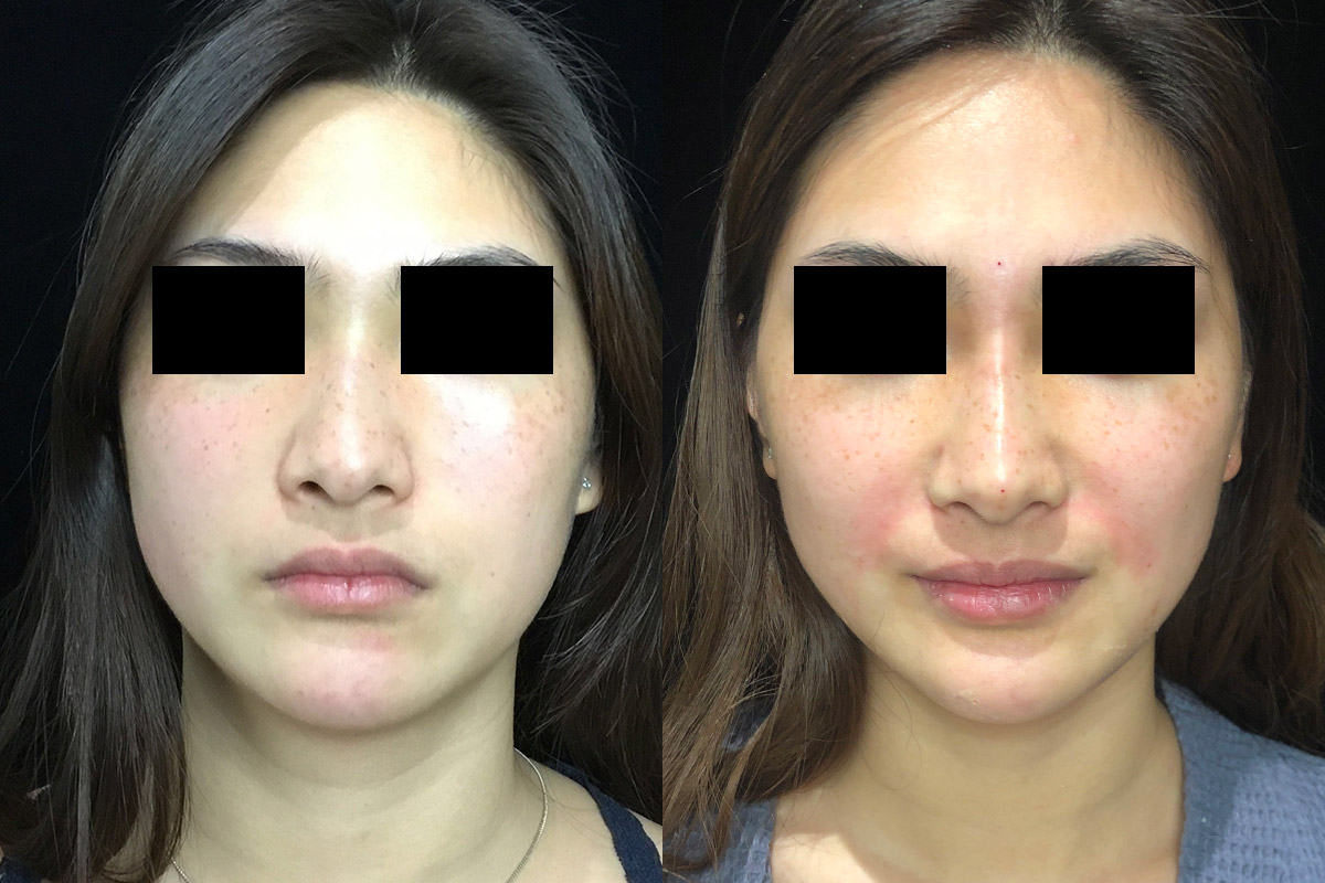 Non Surgical Rhinoplasty Before & After 1