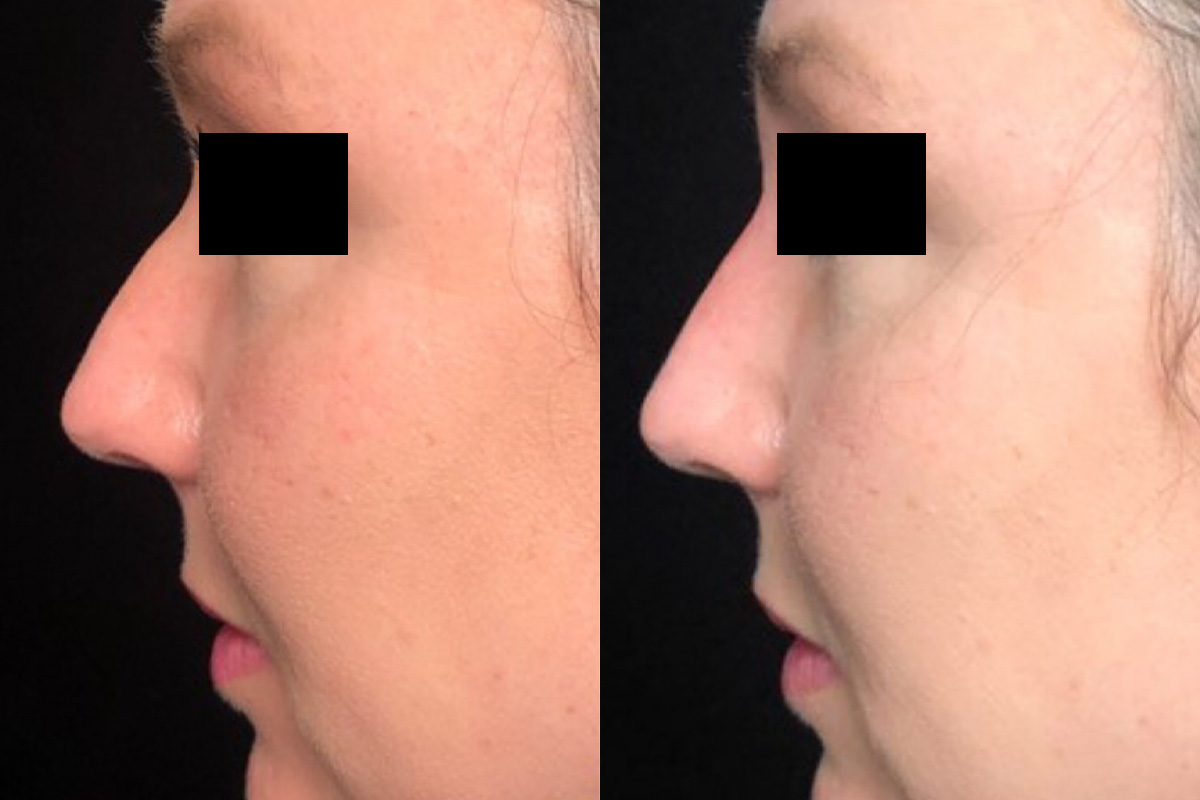 Non Surgical Rhinoplasty Before & After 2