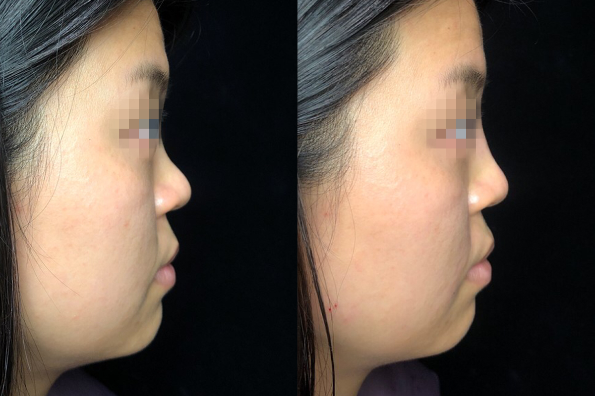 Non Surgical Rhinoplasty Before & After 3