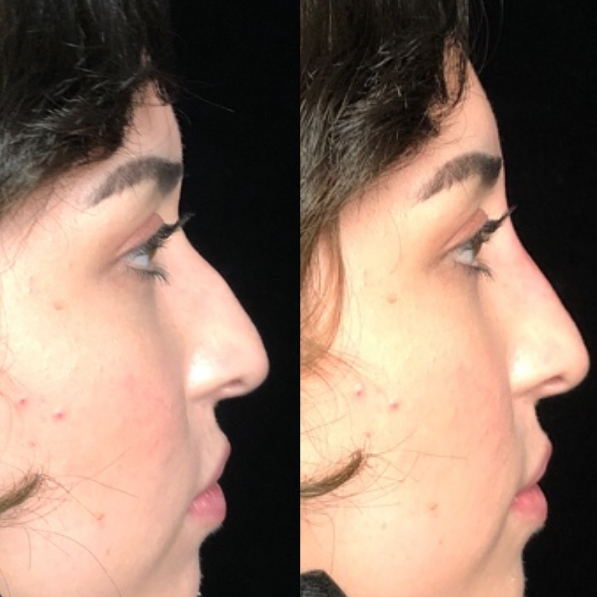 Non Surgical Rhinoplasty Before & After 4