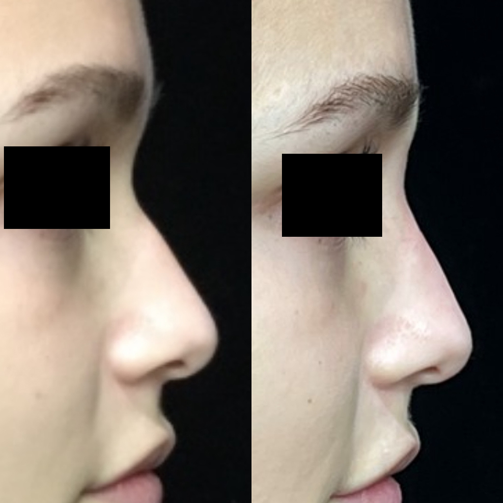 Non Surgical Rhinoplasty Before & After 5
