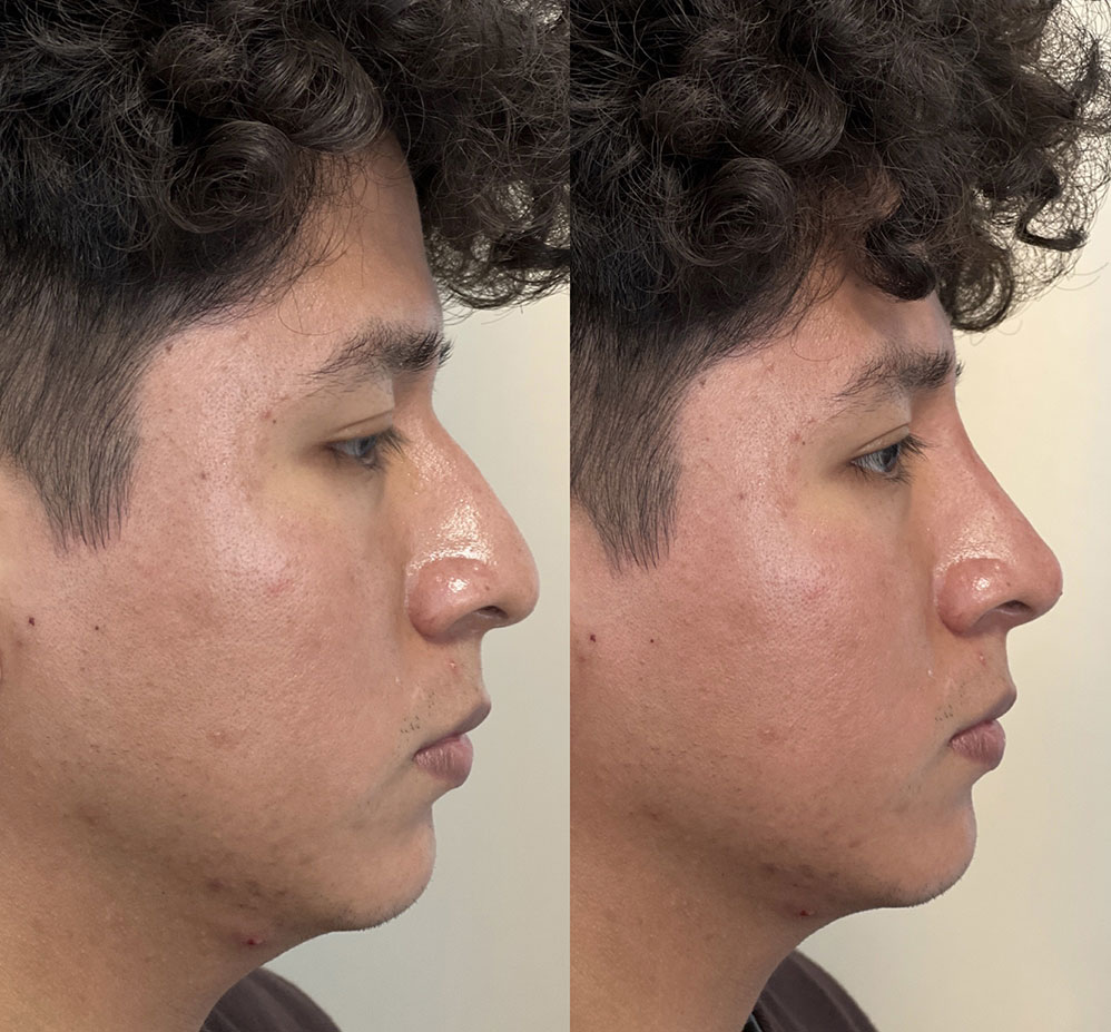 Non Surgical Rhinoplasty Before & After 6