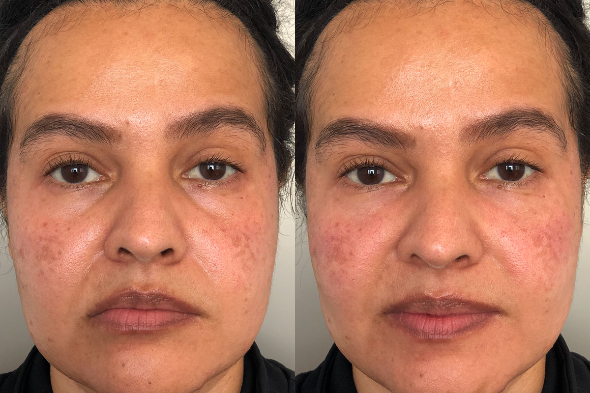 Restylane Before & After 1