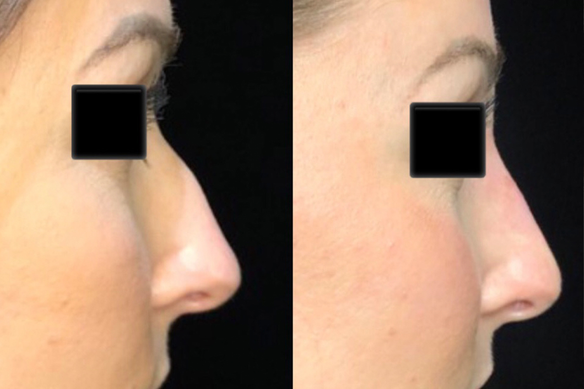 Restylane Before & After 2