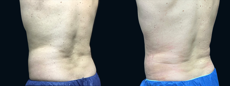 Smartlipo Before & After 1