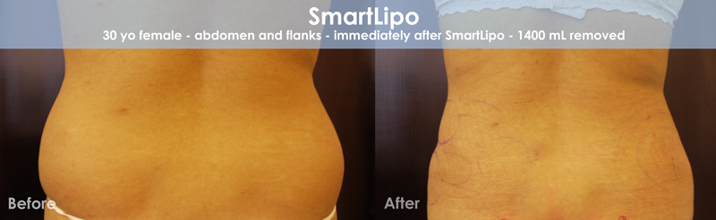 Smartlipo Before & After 2