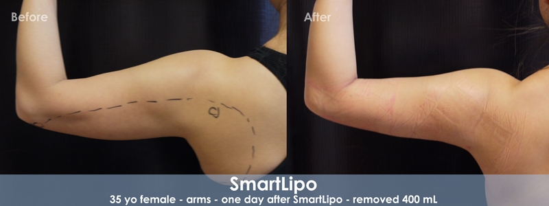 Smartlipo Before & After 3