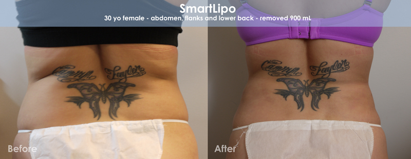 Smartlipo Before & After 4