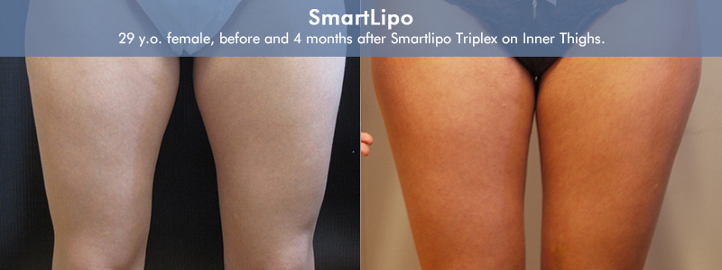 Smartlipo Before & After 6