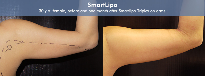 Smartlipo Before & After 7