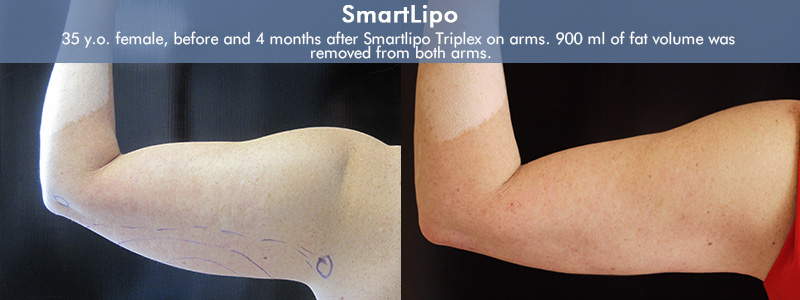 Smartlipo Before & After 8