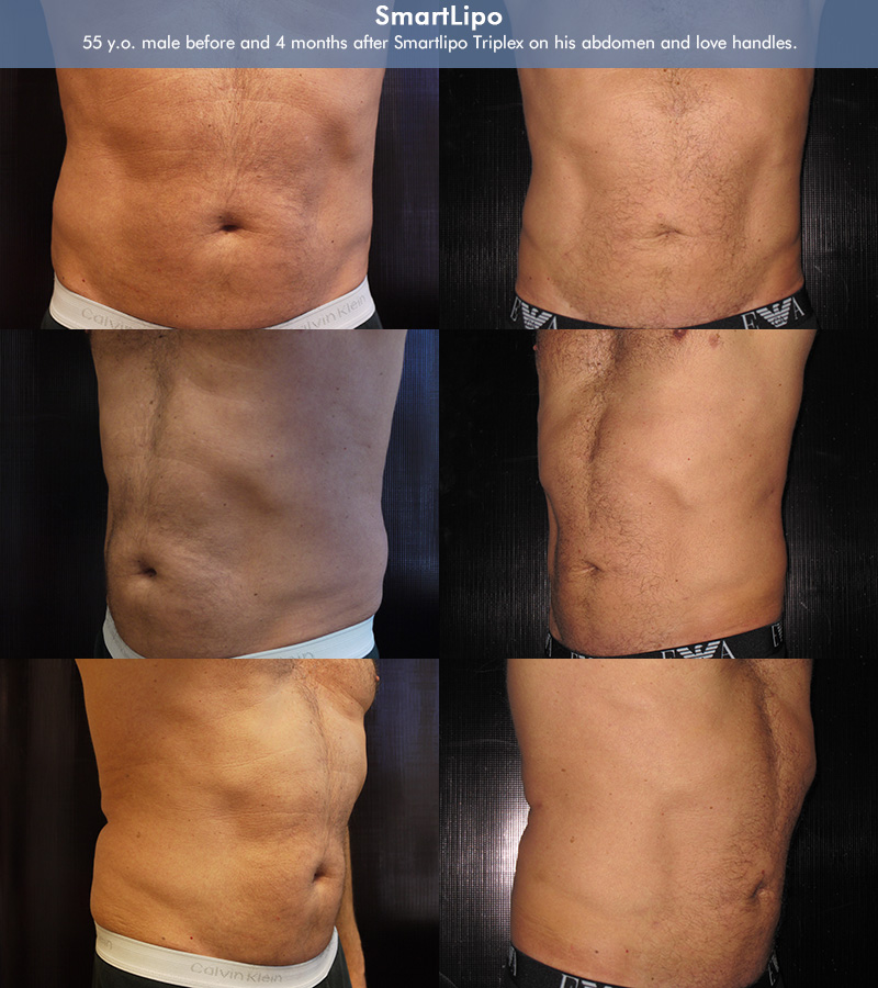 Smartlipo Before & After 9