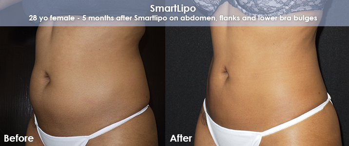 Smartlipo Before & After 10