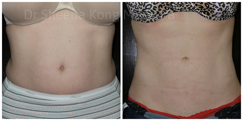 Smartlipo Before & After 11