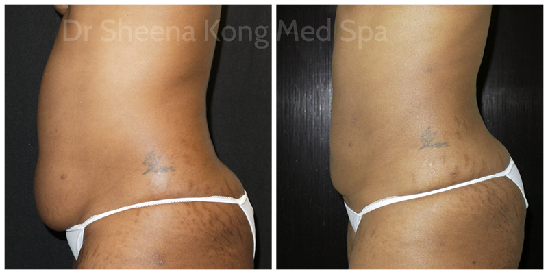 Smartlipo Before & After 12
