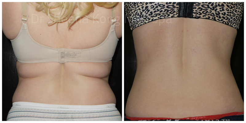 Smartlipo Before & After 17