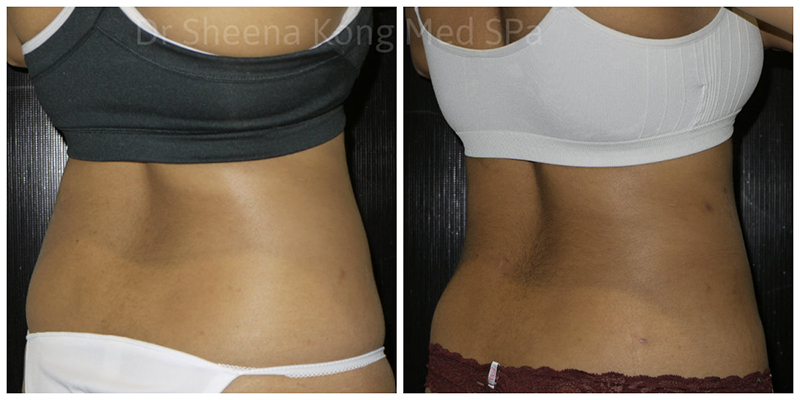 Smartlipo Before & After 18