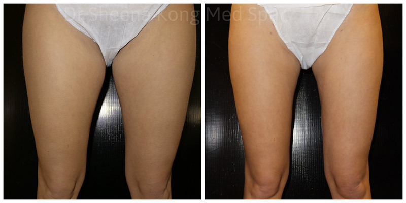 Smartlipo Before & After 19
