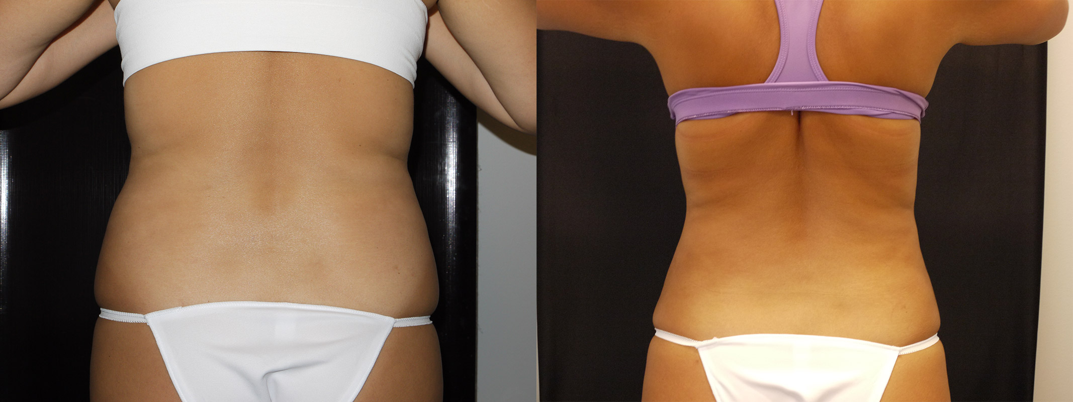 Smartlipo Before & After 20