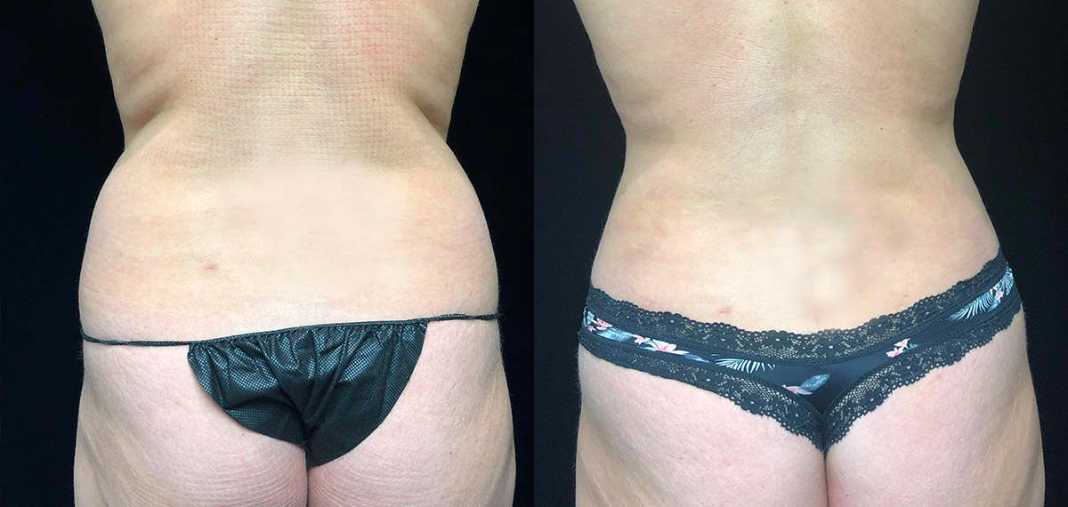 Smartlipo Before & After 21